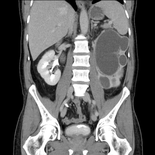 Chronic ureteropelvic junction obstruction (Radiopaedia 78365-90996 B 57).jpg
