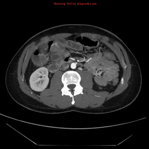 File:Circumaortic left renal vein (Radiopaedia 9069-9792 A 31).jpg