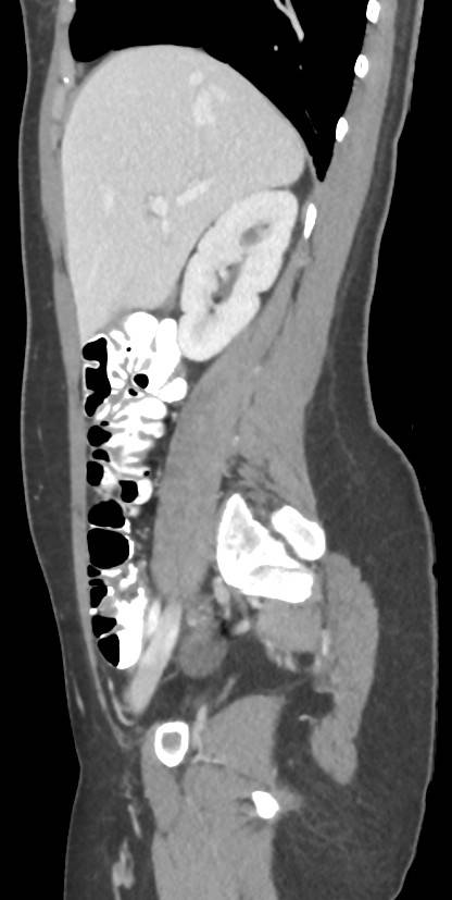 Circumaortic left renal vein with a duplicated retroaortic vein (Radiopaedia 91668-109398 C 38).jpg