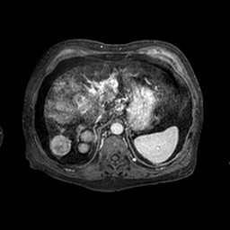 Cirrhosis and hepatocellular carcinoma in the setting of hemochromatosis (Radiopaedia 75394-86594 Axial T1 C+ fat sat 225).jpg