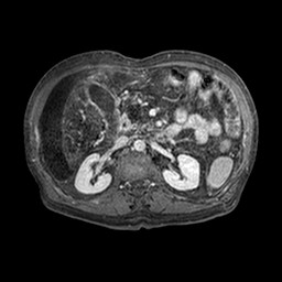 Cirrhosis and hepatocellular carcinoma in the setting of hemochromatosis (Radiopaedia 75394-86594 Axial T1 C+ fat sat 283).jpg