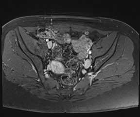 File:Class II Mullerian duct anomaly- unicornuate uterus with rudimentary horn and non-communicating cavity (Radiopaedia 39441-41755 Axial T1 fat sat 45).jpg