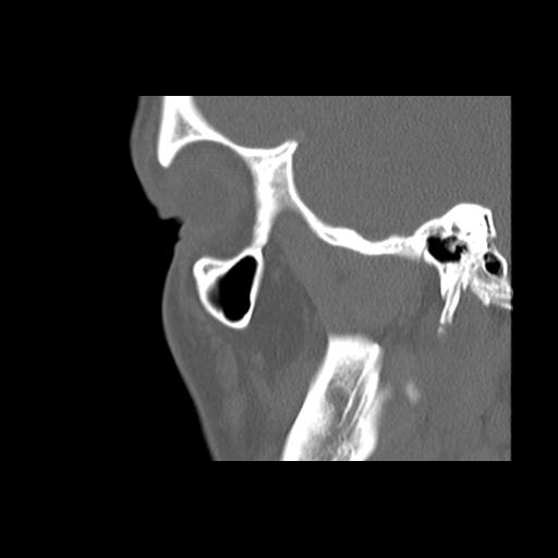 File:Cleft hard palate and alveolus (Radiopaedia 63180-71710 Sagittal bone window 13).jpg