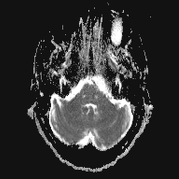 File:Clival meningioma (Radiopaedia 53278-59248 Axial ADC 5).jpg