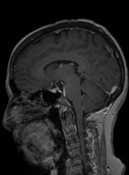 Clival meningioma (Radiopaedia 53278-59248 Sagittal T1 C+ 247).jpg