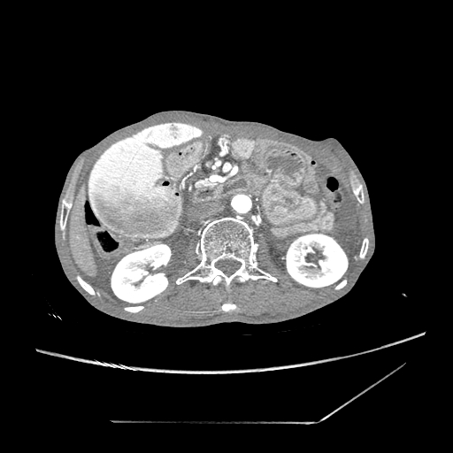 Closed-loop obstruction due to peritoneal seeding mimicking internal hernia after total gastrectomy (Radiopaedia 81897-95864 A 69).jpg