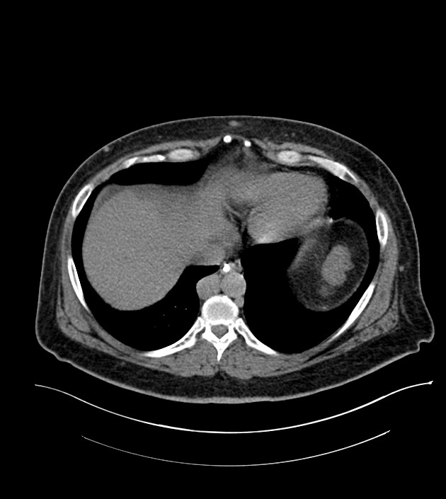 Closed-loop small bowel obstruction-internal hernia (Radiopaedia 78439-91096 Axial non-contrast 18).jpg