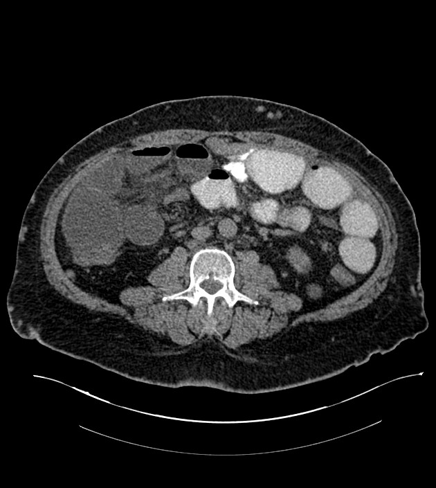 Closed-loop small bowel obstruction-internal hernia (Radiopaedia 78439-91096 Axial non-contrast 84).jpg