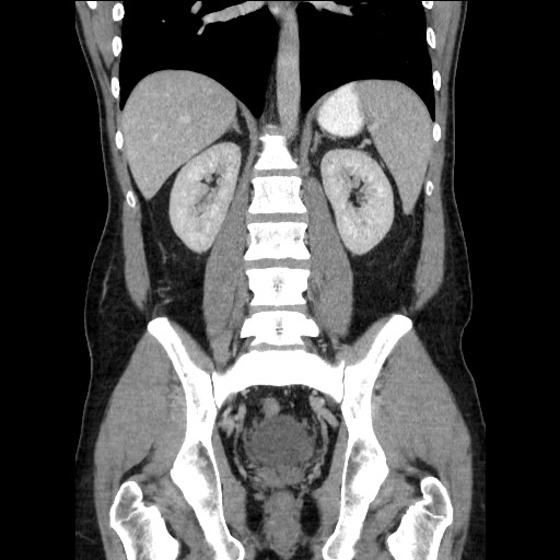 Closed-loop small bowel obstruction (Radiopaedia 73713-84509 C 82).jpg