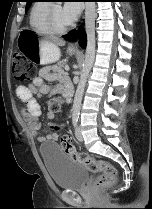 Closed loop obstruction - internal hernia into nephrectomy bed (Radiopaedia 59867-67320 C 43).jpg