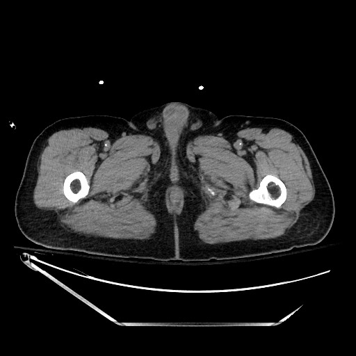 File:Closed loop obstruction due to adhesive band, resulting in small bowel ischemia and resection (Radiopaedia 83835-99023 Axial non-contrast 177).jpg