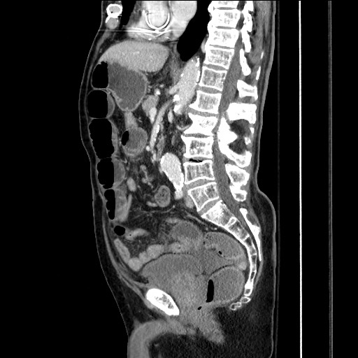 Closed loop obstruction due to adhesive band, resulting in small bowel ischemia and resection (Radiopaedia 83835-99023 F 99).jpg