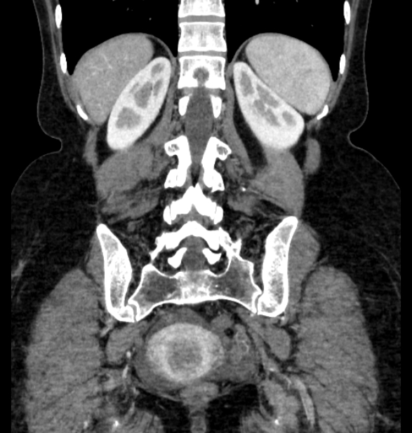 Closed loop small bowel obstruction (Radiopaedia 71211-81508 B 100).jpg