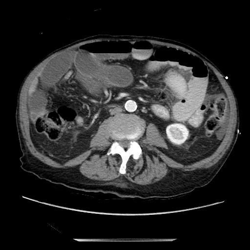 File:Closed loop small bowel obstruction - adhesive disease and hemorrhagic ischemia (Radiopaedia 86831-102990 A 100).jpg