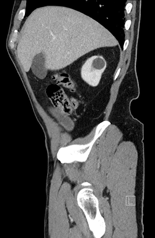 Closed loop small bowel obstruction - internal hernia (Radiopaedia 57806-64778 C 90).jpg