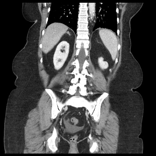 Closed loop small bowel obstruction - internal hernia (Radiopaedia 65402-74450 B 80).jpg