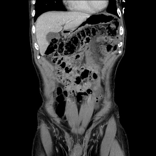 Closed loop small bowel obstruction - omental adhesion causing "internal hernia" (Radiopaedia 85129-100682 B 40).jpg