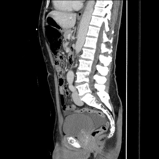 Closed loop small bowel obstruction - omental adhesion causing "internal hernia" (Radiopaedia 85129-100682 C 96).jpg