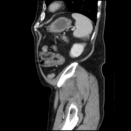 Closed loop small bowel obstruction due to adhesive band - U-shaped loop (Radiopaedia 83829-99012 C 16).jpg