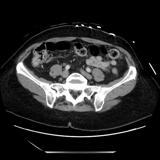 Closed loop small bowel obstruction due to adhesive bands - early and late images (Radiopaedia 83830-99014 A 104).jpg