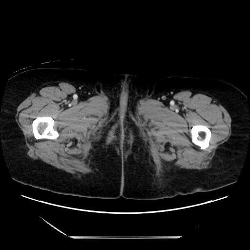 File:Closed loop small bowel obstruction due to adhesive bands - early and late images (Radiopaedia 83830-99014 A 177).jpg