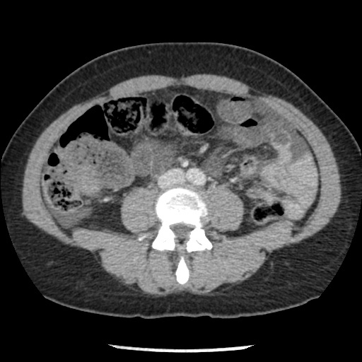 File:Closed loop small bowel obstruction due to trans-omental herniation (Radiopaedia 35593-37109 A 49).jpg
