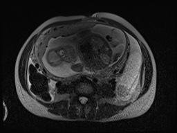 File:Closed loop small bowel obstruction in pregnancy (MRI) (Radiopaedia 87637-104031 D 9).jpg