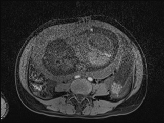Closed loop small bowel obstruction in pregnancy (MRI) (Radiopaedia 87637-104031 F 17).jpg