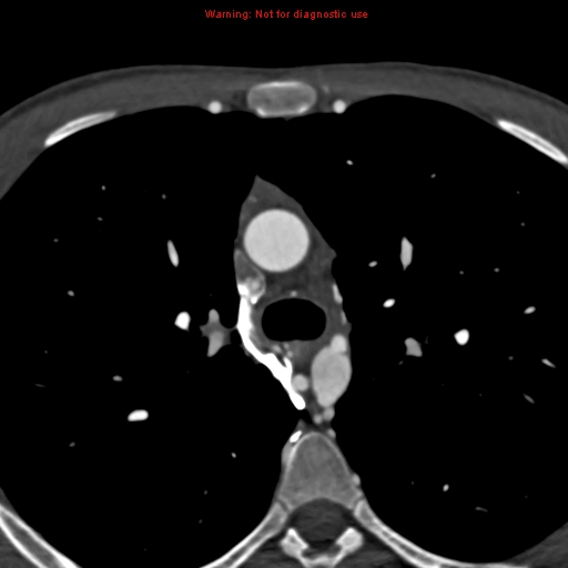 File:Coarctation of the aorta (Radiopaedia 12461-12697 A 123).jpg