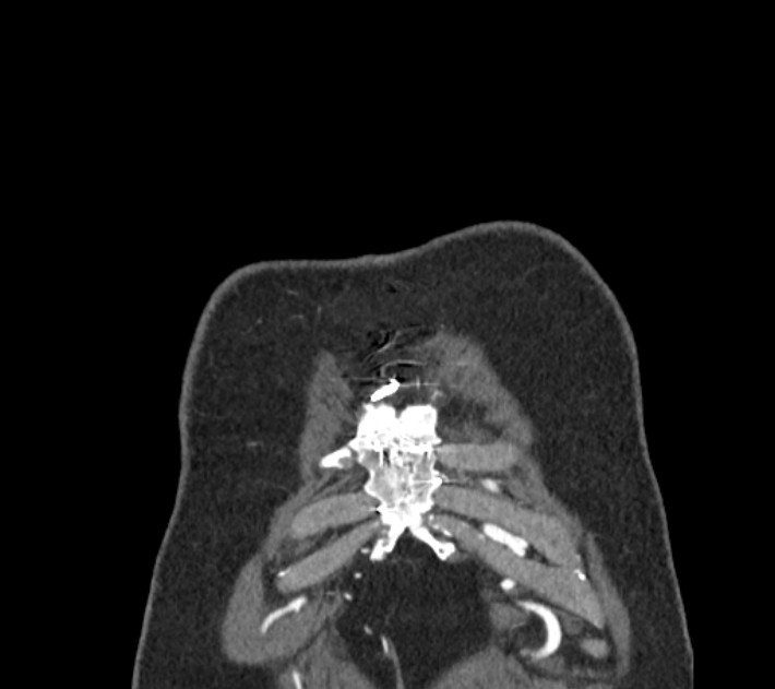 Coarctation of the aorta (Radiopaedia 53752-59822 B 3).jpg