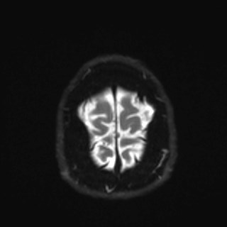 Cochlear incomplete partition type III associated with hypothalamic hamartoma (Radiopaedia 88756-105498 Axial DWI 39).jpg