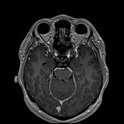 File:Cochlear incomplete partition type III associated with hypothalamic hamartoma (Radiopaedia 88756-105498 Axial T1 C+ 81).jpg