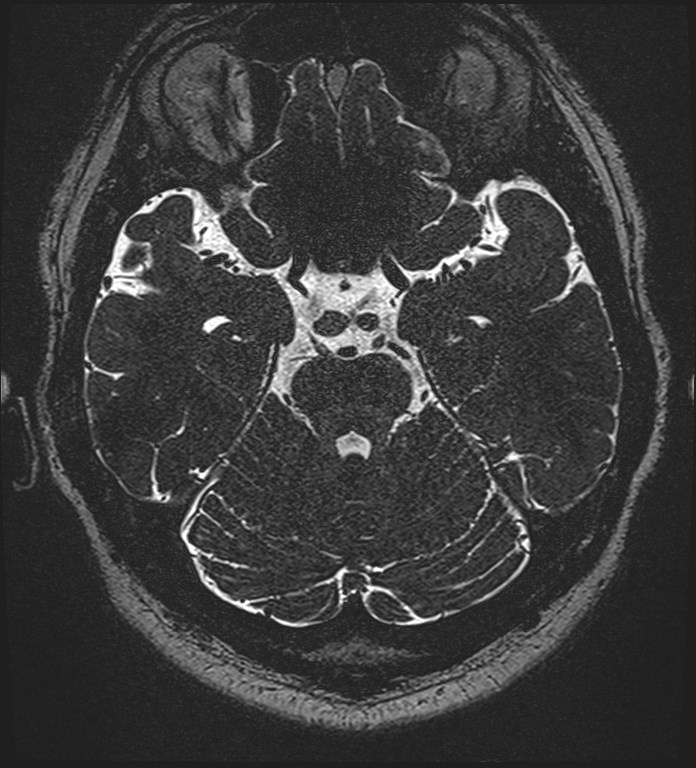 Cochlear incomplete partition type III associated with hypothalamic hamartoma (Radiopaedia 88756-105498 Axial T2 125).jpg