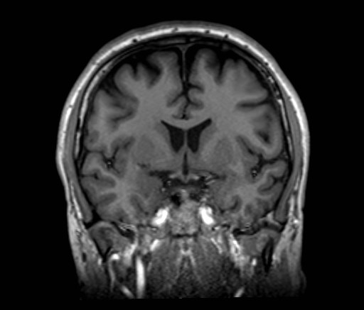 File:Cochlear incomplete partition type III associated with hypothalamic hamartoma (Radiopaedia 88756-105498 Coronal T1 38).jpg