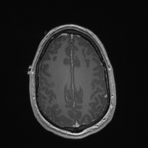 File:Colloid cyst (Radiopaedia 44510-48181 Axial T1 C+ 140).png