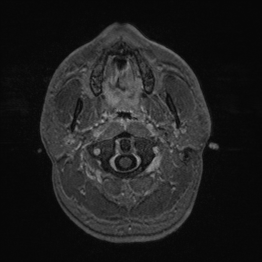 File:Colloid cyst (Radiopaedia 44510-48181 Axial T1 C+ 15).png