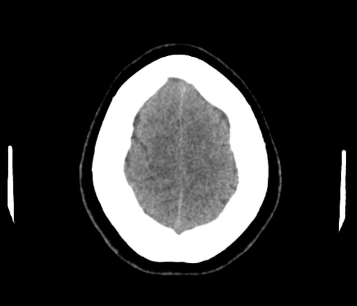 Colloid cyst (Radiopaedia 53180-59146 Axial non-contrast 94).jpg