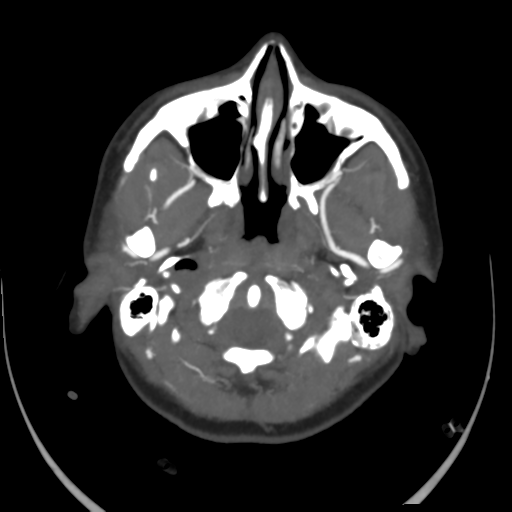 File:Colloid cyst (resulting in death) (Radiopaedia 33423-34499 A 6).png