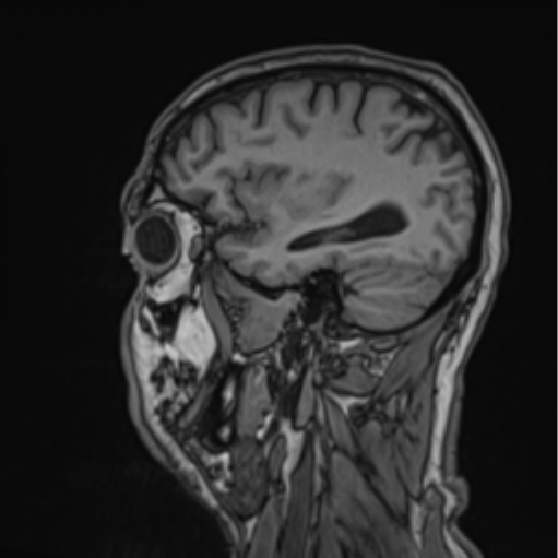 Colloid cyst of the third ventricle (Radiopaedia 86571-102662 Sagittal T1 21).png