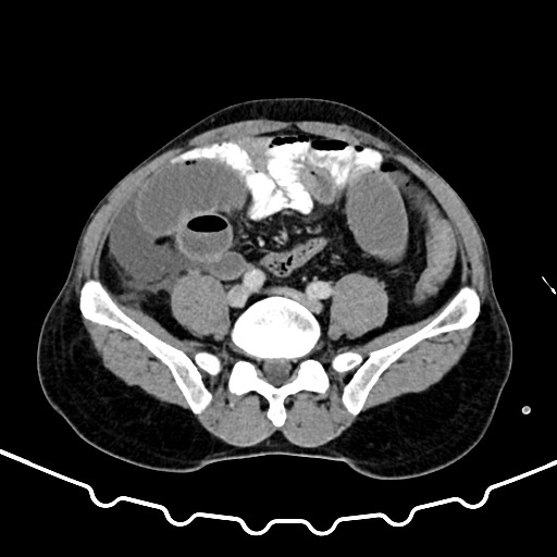 File:Colocolic intussusception due to large lipoma (Radiopaedia 68773-78482 A 130).jpg