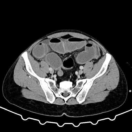 Colocolic intussusception due to large lipoma (Radiopaedia 68773-78482 A 149).jpg