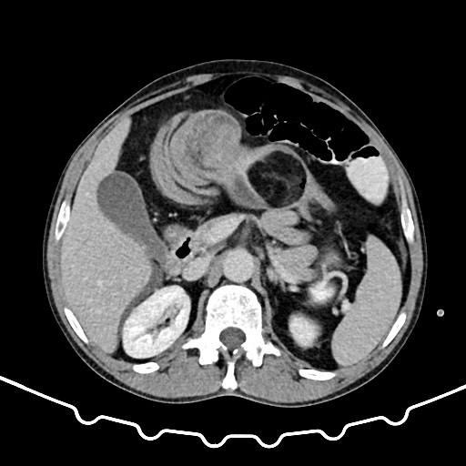 Colocolic intussusception due to large lipoma (Radiopaedia 68773-78482 A 54).jpg