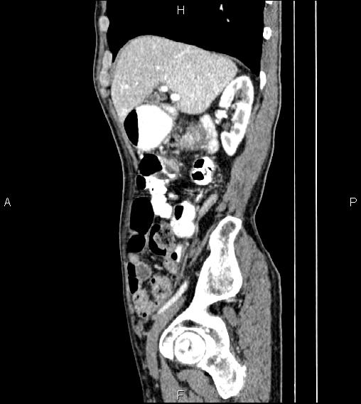 File:Colon adenocarcinoma - hepatic flexure (Radiopaedia 85635-101395 D 25).jpg