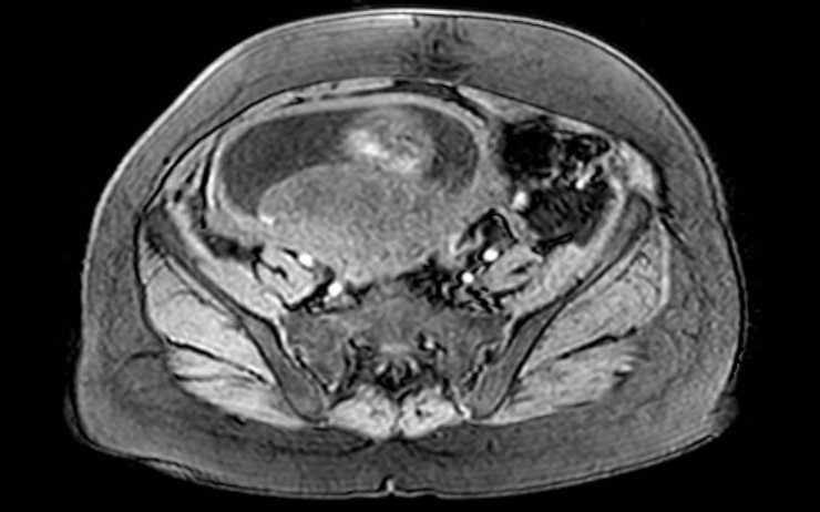 Colon adenocarcinoma with Krukenberg tumors, advanced pregnancy (Radiopaedia 67279-76645 A 26).jpg