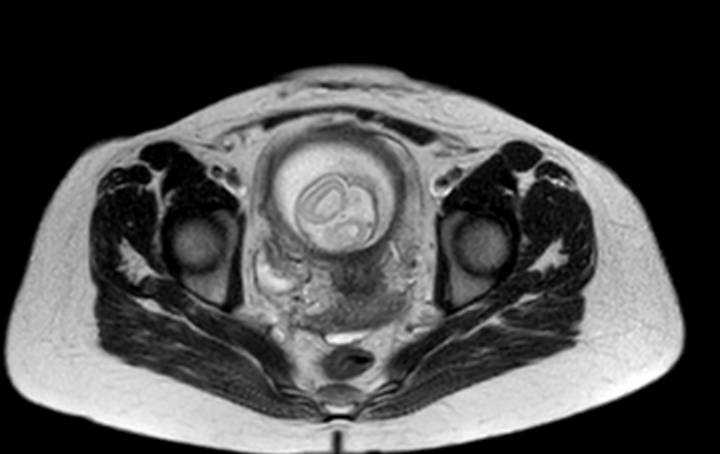 Colon adenocarcinoma with Krukenberg tumors, advanced pregnancy (Radiopaedia 67279-76645 Axial T2 11).jpg