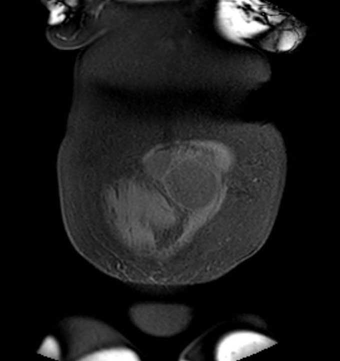 Colon adenocarcinoma with Krukenberg tumors, advanced pregnancy (Radiopaedia 67279-76645 E 3).jpg