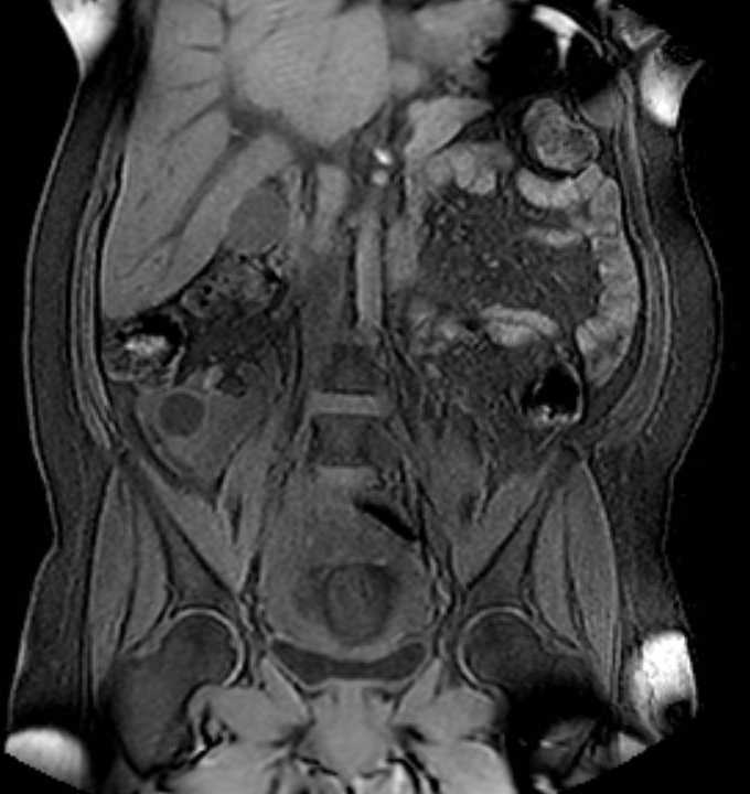 Colon adenocarcinoma with Krukenberg tumors, advanced pregnancy (Radiopaedia 67279-76645 E 47).jpg