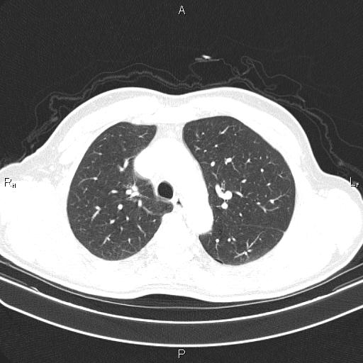 File:Colon cancer (Radiopaedia 85663-101443 Axial lung window 20).jpg