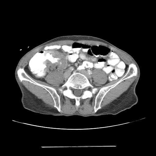 Colon cancer with calcified liver metastasis (Radiopaedia 74423-85307 A 51).jpg