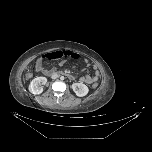 Colonic infarction after colostomy creation (Radiopaedia 81157-94797 A 84).jpg